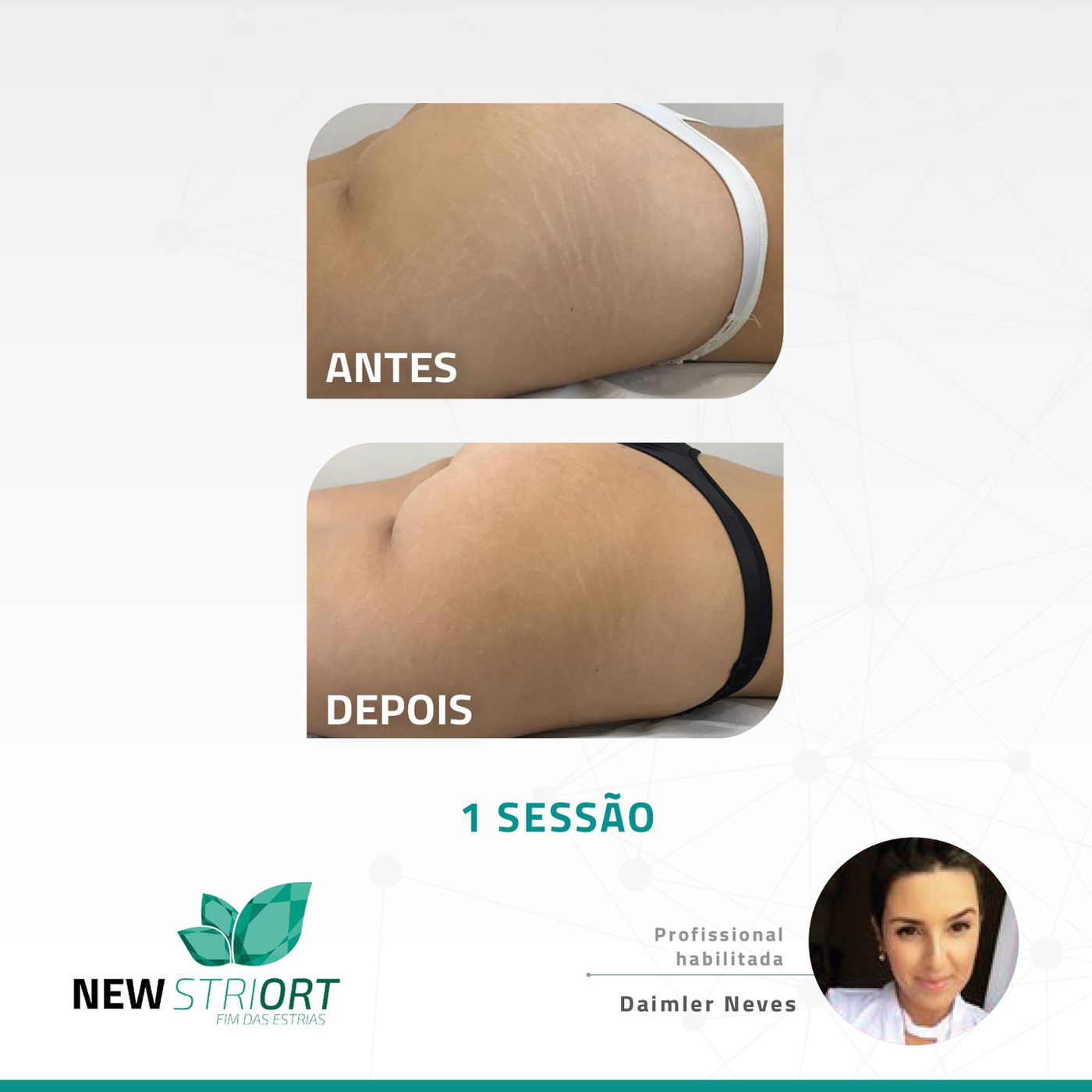 Antes e depois — tratamento de estrias por profissional habilitada