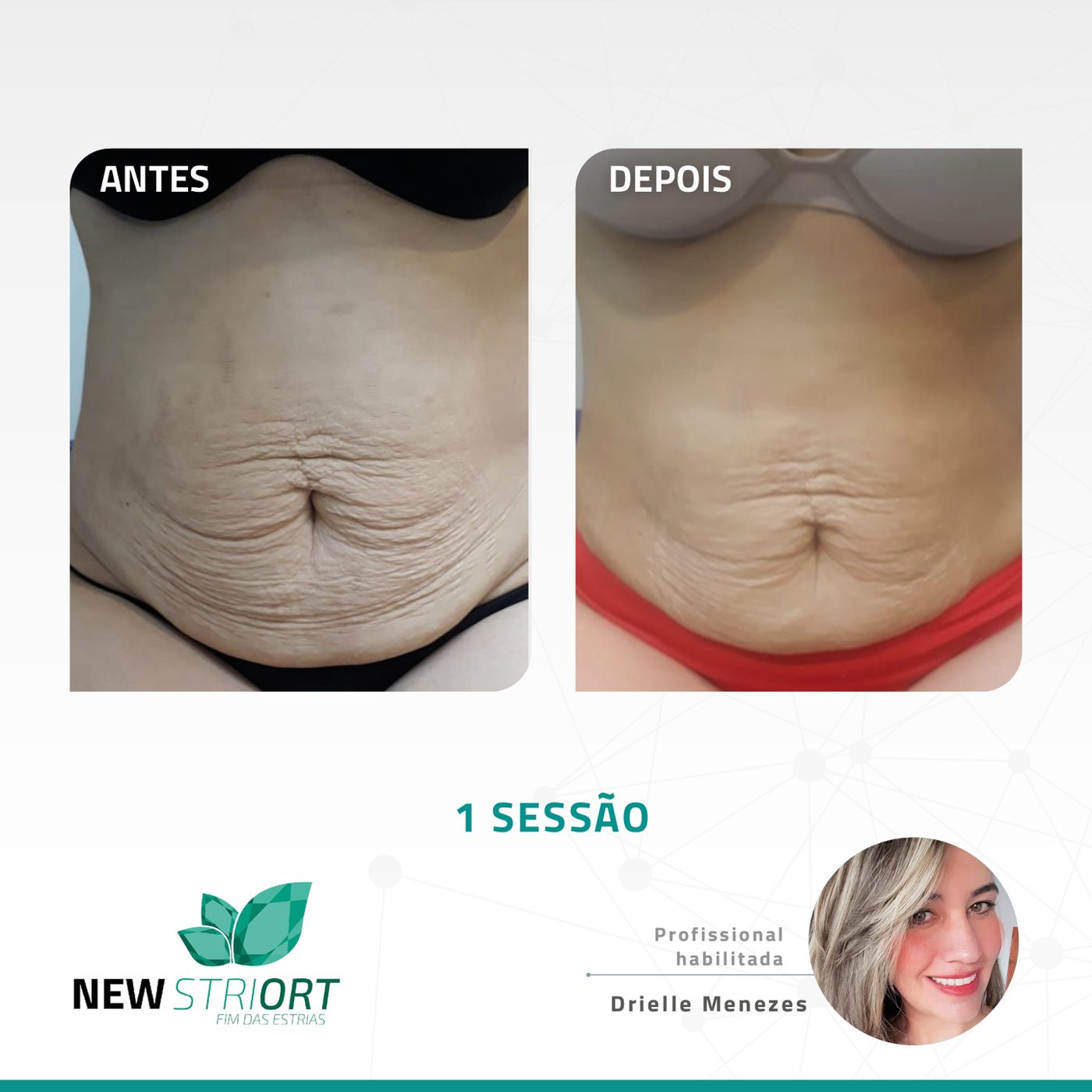 Antes e depois — tratamento de estrias por profissional habilitada