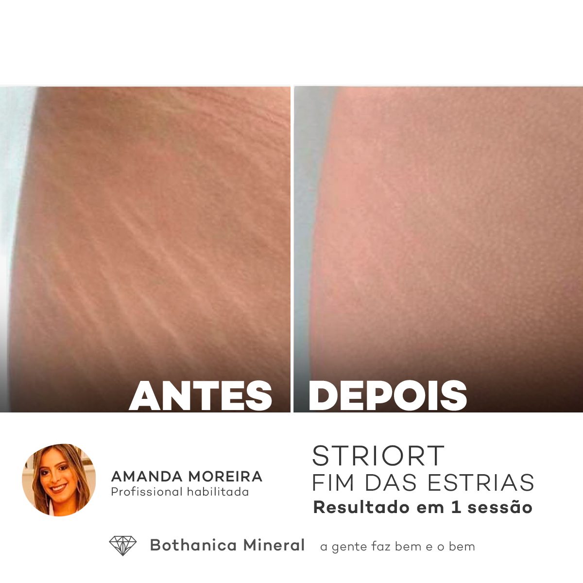 Antes e depois — tratamento de estrias por profissional habilitada