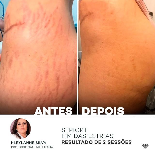 Antes e depois — tratamento de estrias por profissional habilitada