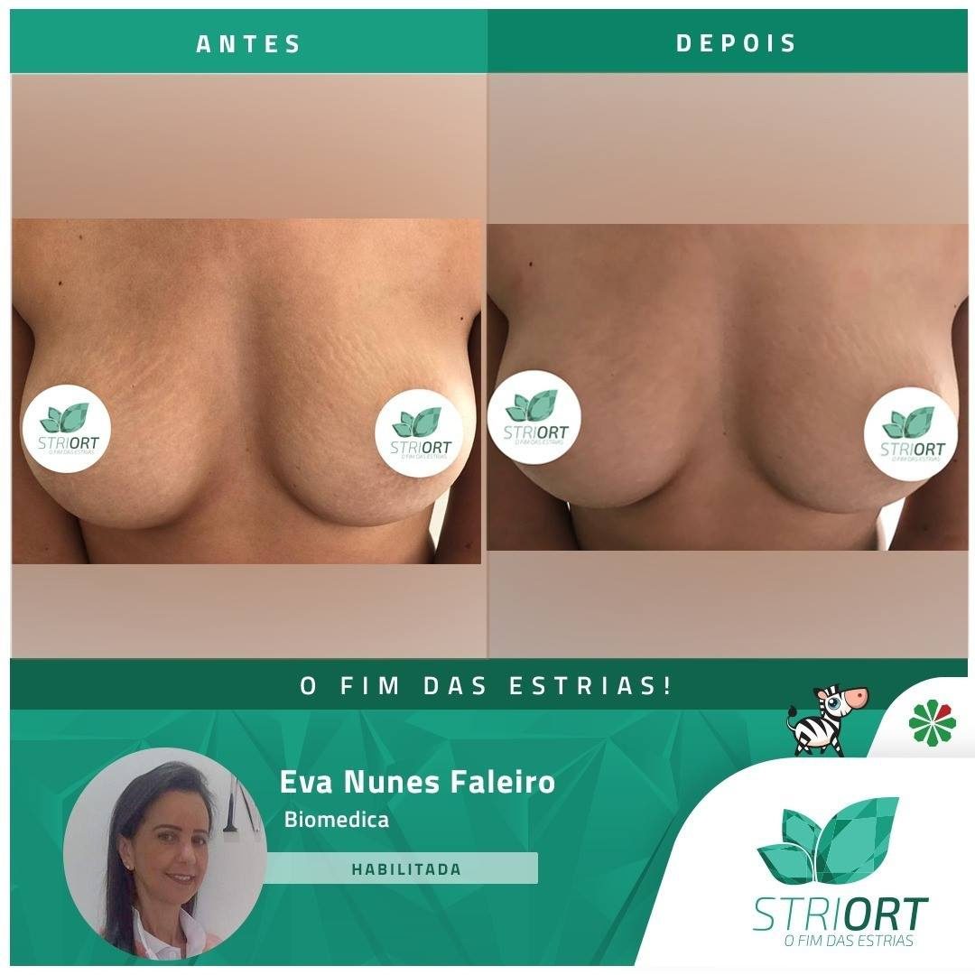 Antes e depois — tratamento de estrias por profissional habilitada