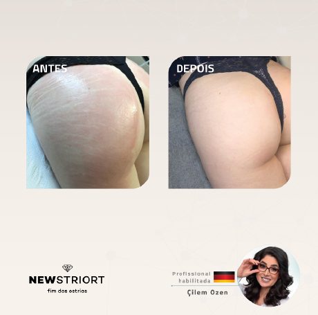Antes e depois — tratamento de estrias por profissional habilitada