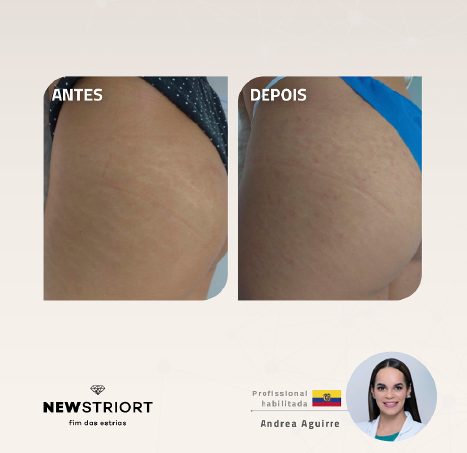 Antes e depois — tratamento de estrias por profissional habilitada
