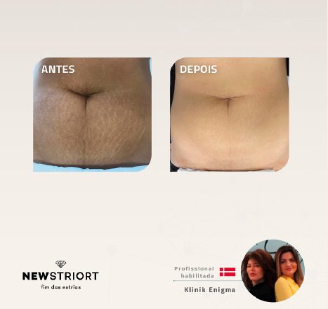Antes e depois — tratamento de estrias por profissional habilitada