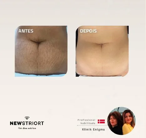 Antes e depois — tratamento de estrias por profissional habilitada