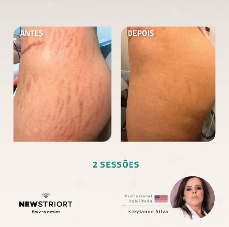 Antes e depois — tratamento de estrias por profissional habilitada