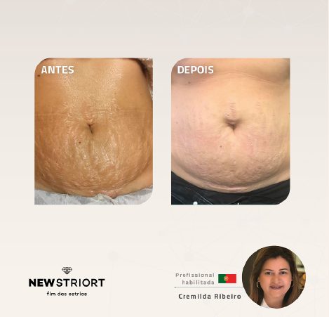 Antes e depois — tratamento de estrias por profissional habilitada