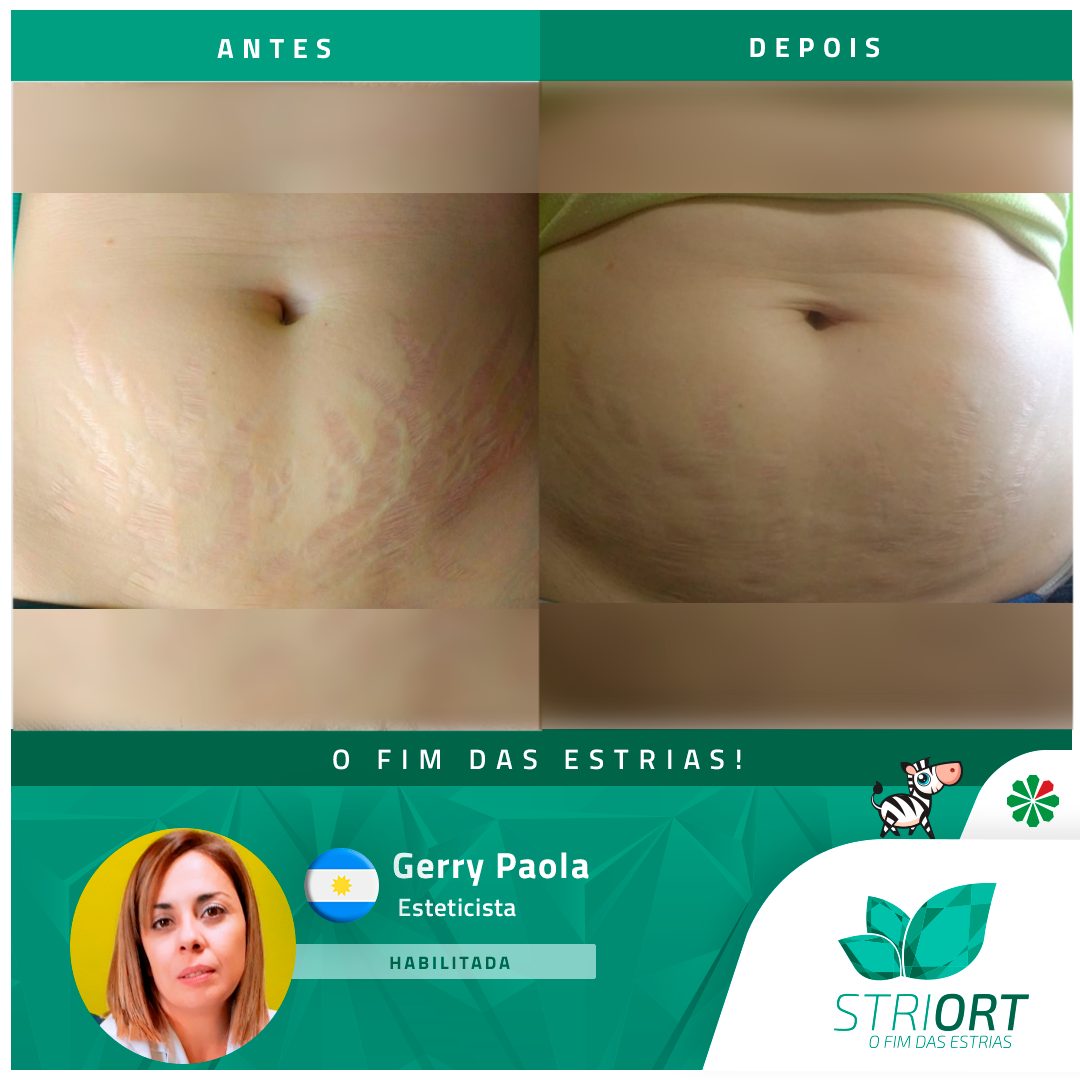 Antes e depois — tratamento de estrias por profissional habilitada
