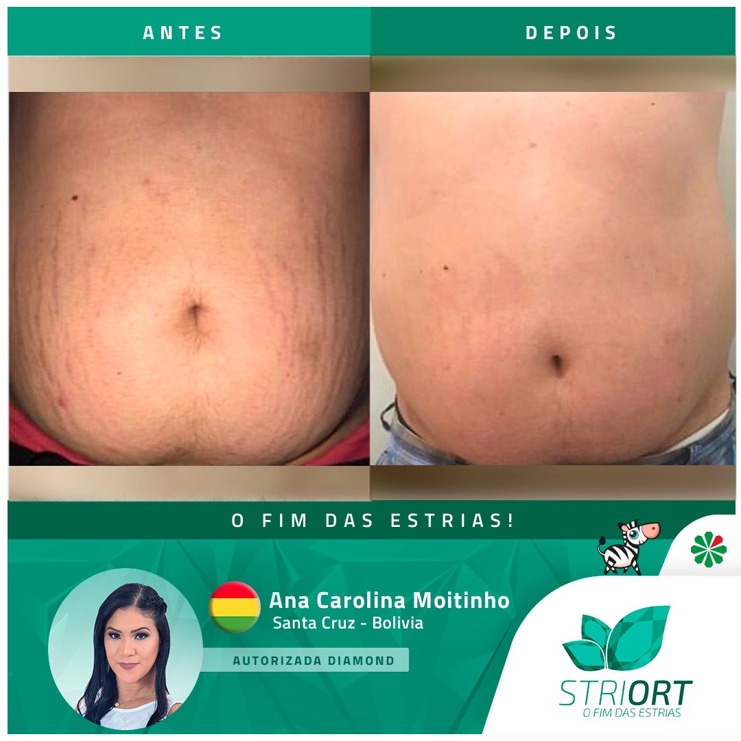 Antes e depois — tratamento de estrias por profissional habilitada