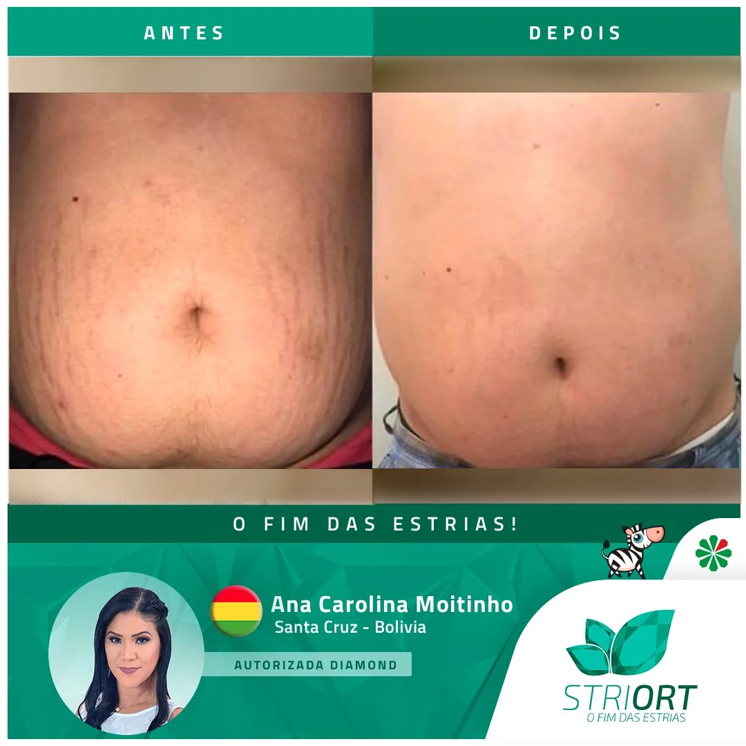 Antes e depois — tratamento de estrias por profissional habilitada