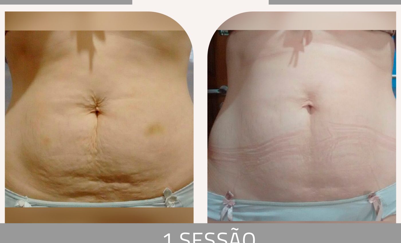 Antes e depois — tratamento de estrias por profissional habilitada