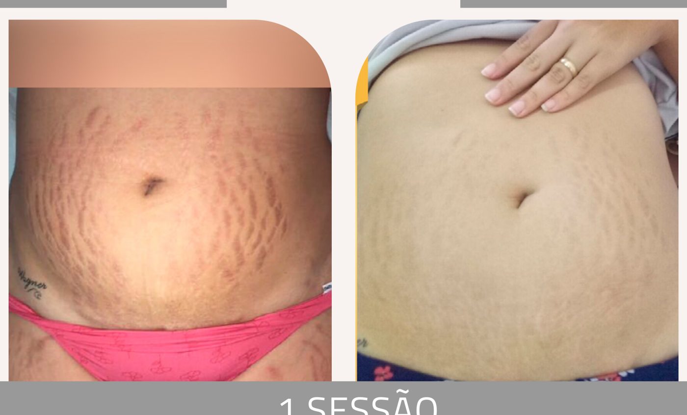 Antes e depois — tratamento de estrias por profissional habilitada