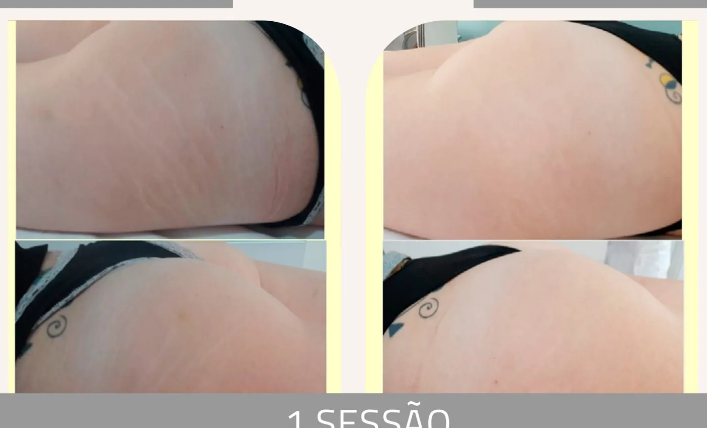 Antes e depois — tratamento de estrias por profissional habilitada