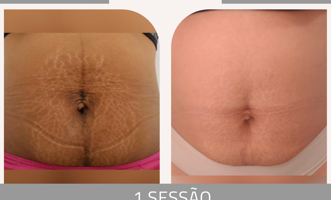 Antes e depois — tratamento de estrias por profissional habilitada