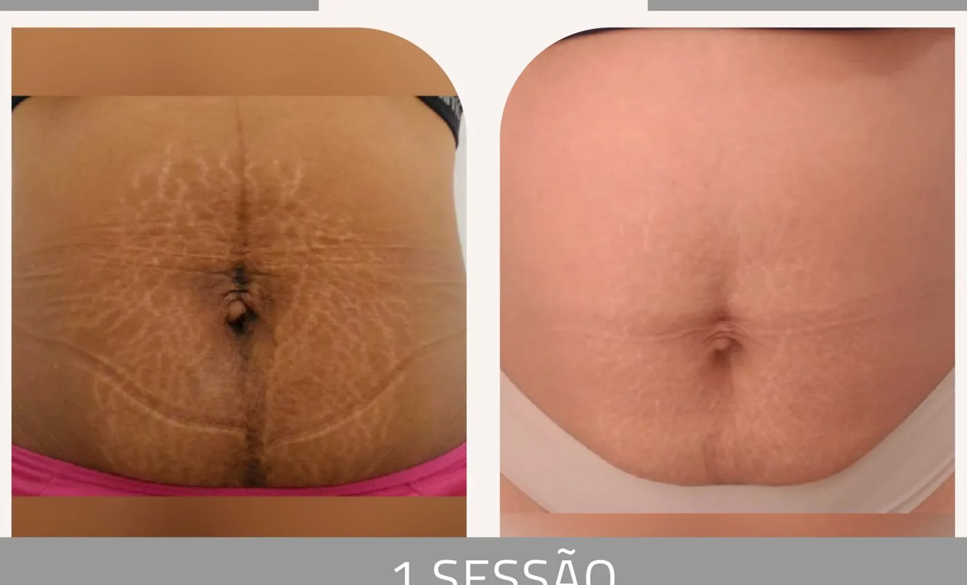 Antes e depois — tratamento de estrias por profissional habilitada