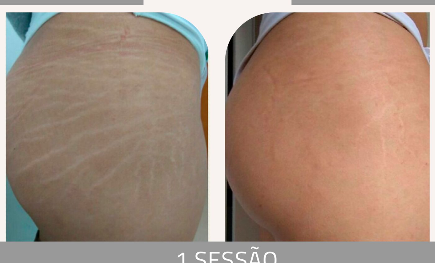 Antes e depois — tratamento de estrias por profissional habilitada
