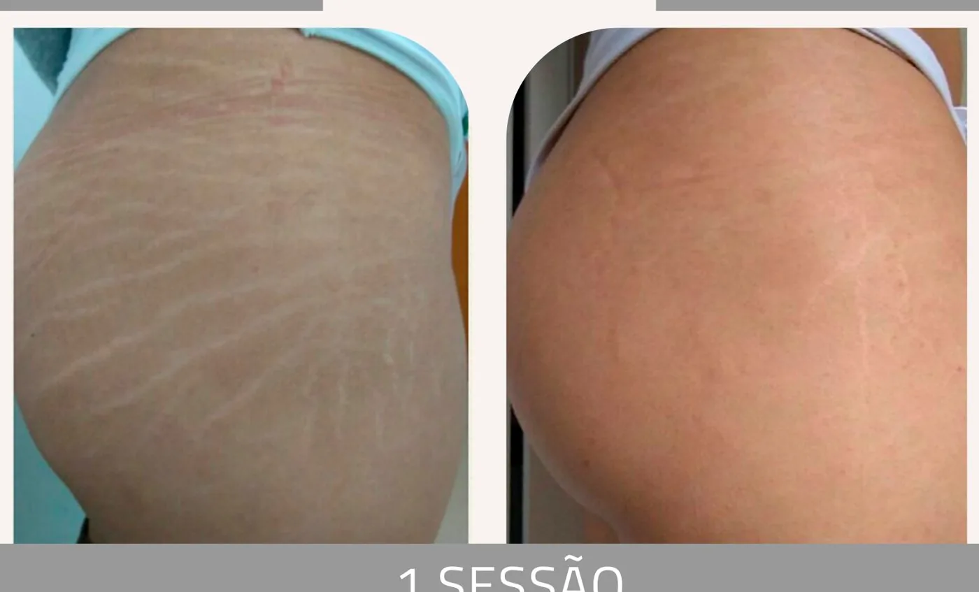 Antes e depois — tratamento de estrias por profissional habilitada