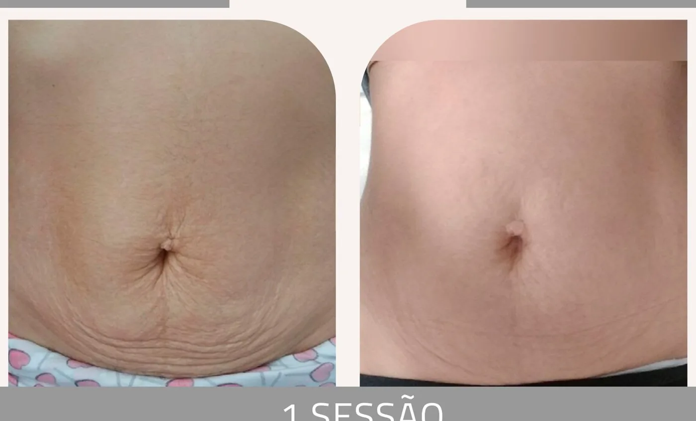 Antes e depois — tratamento de estrias por profissional habilitada