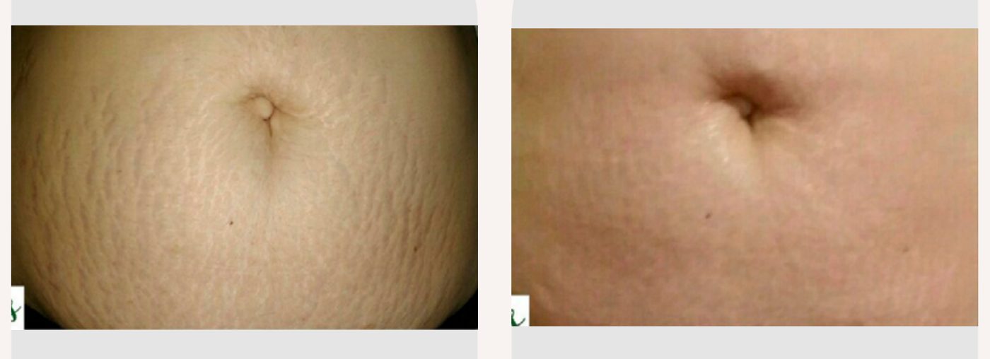 Antes e depois — tratamento de estrias por profissional habilitada