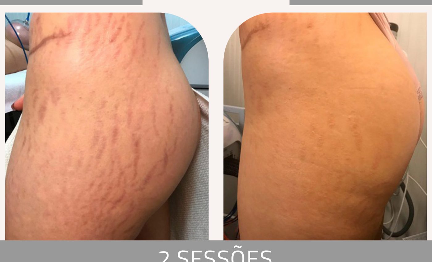 Antes e depois — tratamento de estrias por profissional habilitada