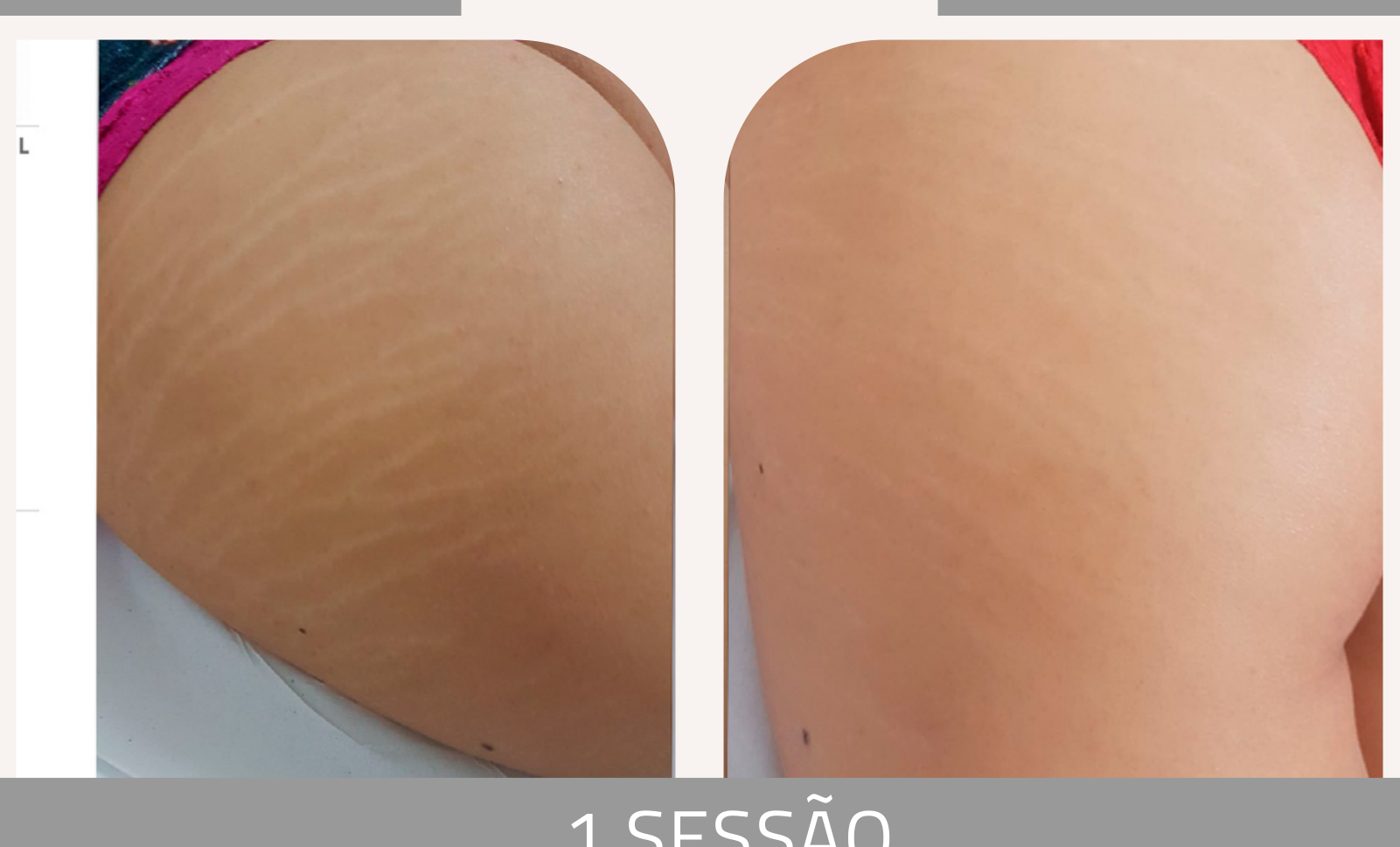 Antes e depois — tratamento de estrias por profissional habilitada