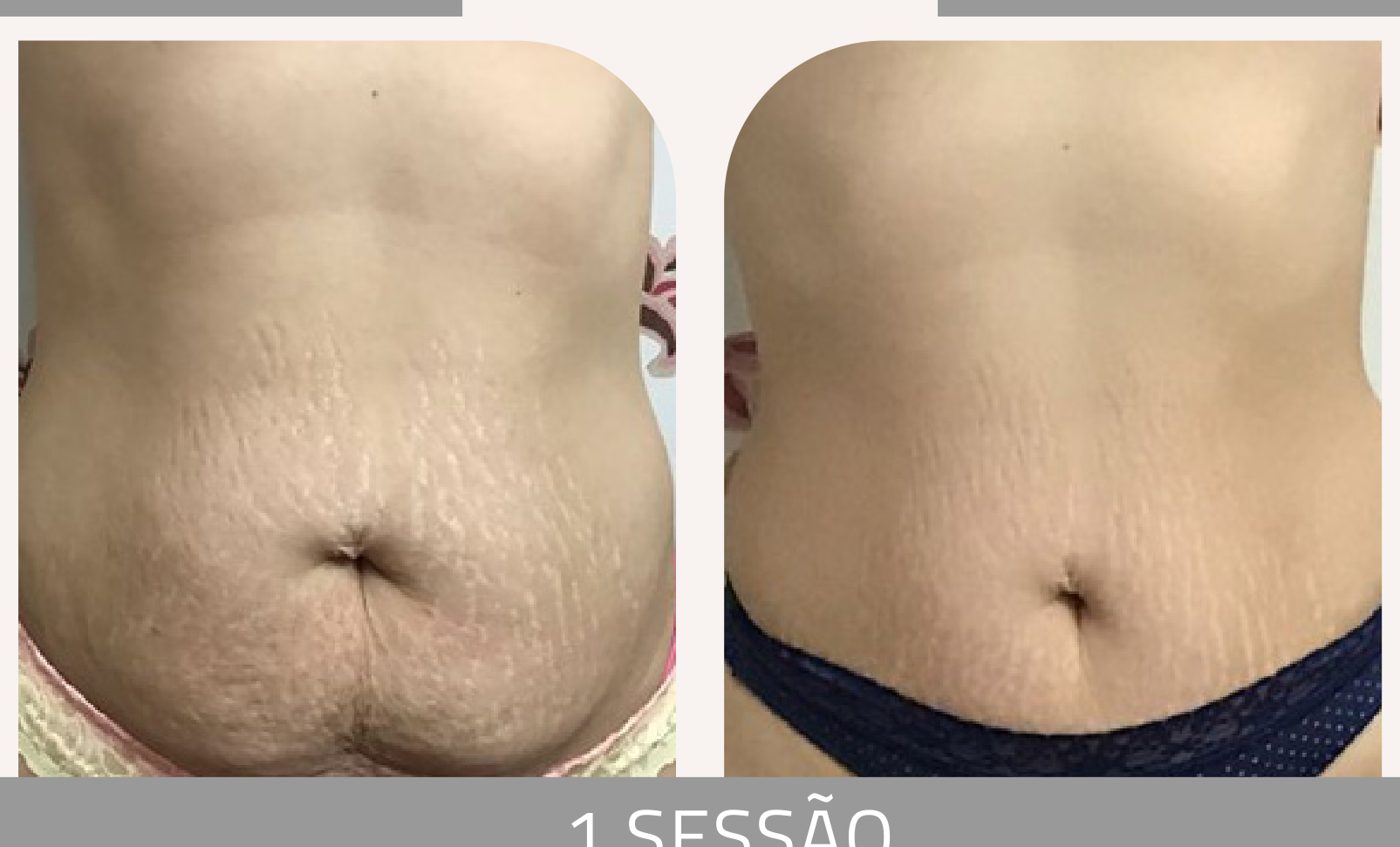 Antes e depois — tratamento de estrias por profissional habilitada