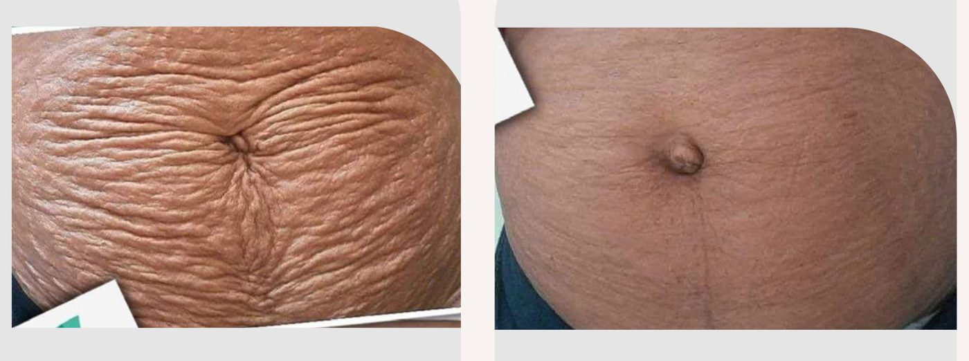 Antes e depois — tratamento de estrias por profissional habilitada