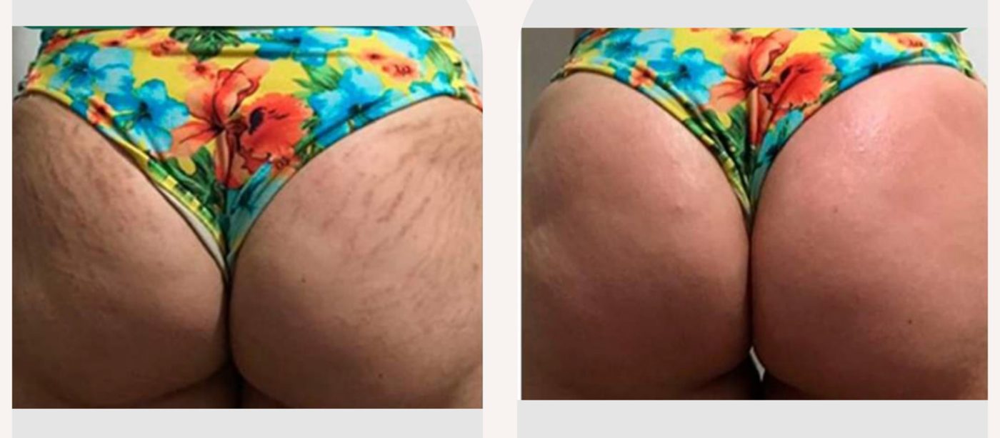 Antes e depois — tratamento de estrias por profissional habilitada