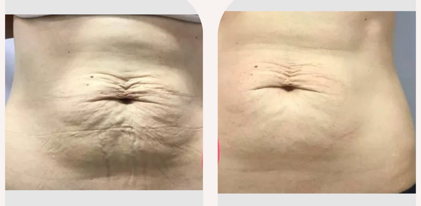 Antes e depois — tratamento de estrias por profissional habilitada