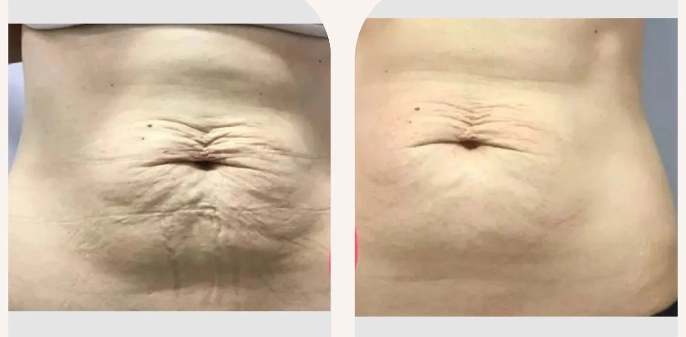 Antes e depois — tratamento de estrias por profissional habilitada