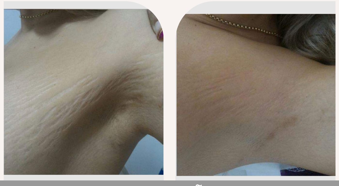 Antes e depois — tratamento de estrias por profissional habilitada