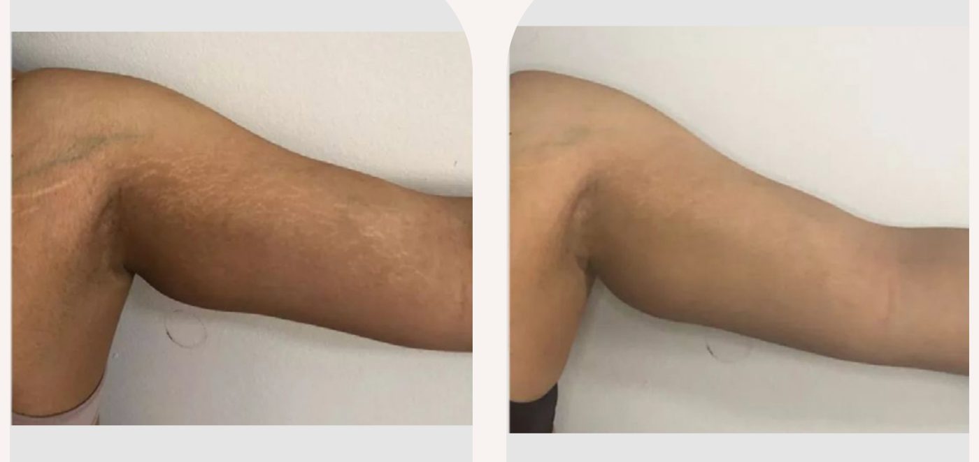 Antes e depois — tratamento de estrias por profissional habilitada