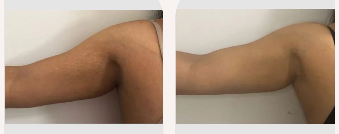 Antes e depois — tratamento de estrias por profissional habilitada